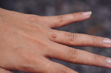 Goodbye Warts, Hello Profits: Stocking Up on High-Demand Wart Removal Solutions
